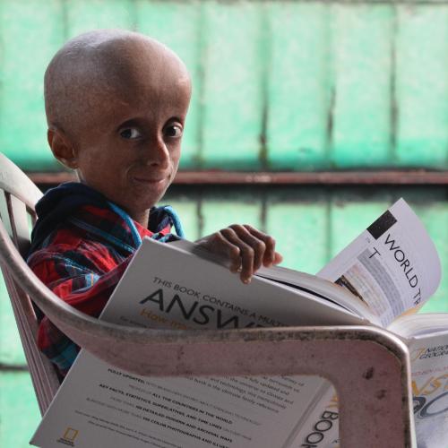 Progeria to choroba powodująca przyspieszone starzenie organizmu. (Fot. BEW)