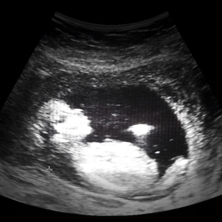 19906704 - ultrasound film of thirteen week fetus