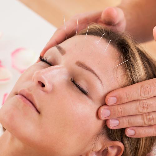 Akupunktura jest pomocna przy leczeniu migreny i zaburzeń snu. (Fot. iStock)