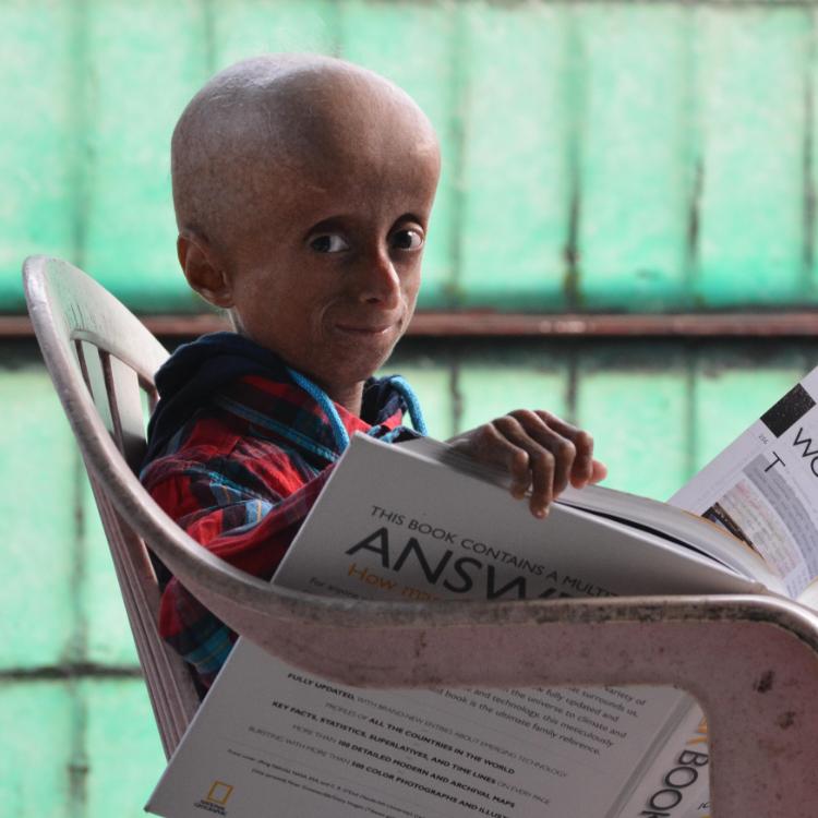 Progeria to choroba powodująca przyspieszone starzenie organizmu. (Fot. BEW)